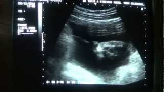 ASCITES ultrasound case study [upl. by Ytak]