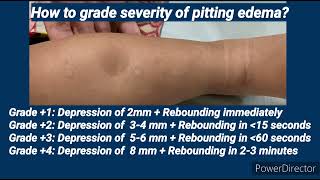 Pitting Edema I Pediatrics [upl. by Alleda]