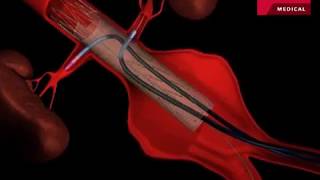 Fenestrated Endovascular Graft to Repair Abdominal Aortic Aneurysm [upl. by Aslehc]