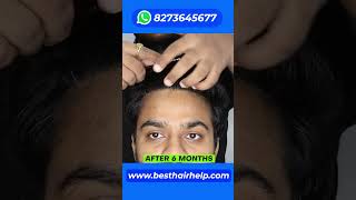 3 Hair Transplant Results Of 1000 2000 And 3000 Grafts In 1 Minute 🔥🔥🔥 hairtransplantresults [upl. by Munford]