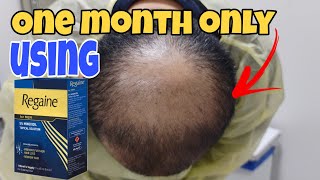 One month using minoxidil Regaine for men 5 before regaine minoxidil SerARTvlog [upl. by Nnylg]