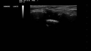 Ultrasonido de articulación acromioclavicular con luxación asociada a desgarro del supraespinoso [upl. by Avah]