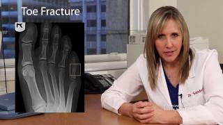 Buddy Splint for Toe Fractures  San Francisco Podiatrist [upl. by Ainiger]