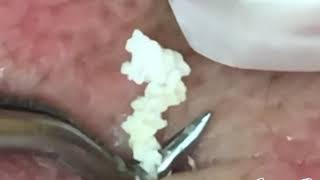 Creamy Removal of Whiteheads and Blackheads on Face and Forehead [upl. by Atiloj]