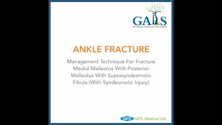 Ankle Fracture  Management Technique for Fracture Medial Malleolus with Posterior Malleolus [upl. by Eiralc600]