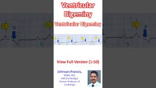 Ventricular Bigeminy [upl. by Ahsoyek]