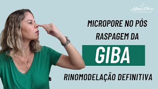 Raspagem de giba e micropore rinomodelacaodefinitiva rinoplastiaestruturada posoperatorio [upl. by Helban743]