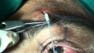 PTOSIS SURGERY VIA SUPRABROW SINGLE STAB INCISIONnew technique frontalis sling Soosan Jacobmpg [upl. by Trebleda]