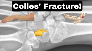 Colles’ Fracture facts shorts collesfracture [upl. by Babette965]