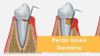 Perda óssea Dentária [upl. by Nikoletta986]