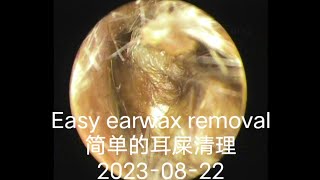 Easy earwax removal简单的耳屎清理20230822 [upl. by Frost]