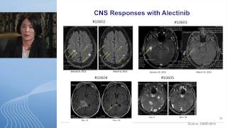 Segment 2 Molecular Targets in NSCLC [upl. by Ahsekahs]