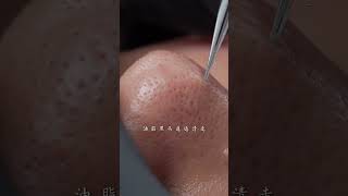 Take good care of your skin during the season change immersiveskincare blackheads asmr facespa [upl. by Millford577]