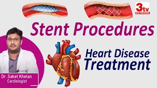 Stent Procedure for Heart Blocks I Heart Disease Treatment I Dr Saket [upl. by Attelahs40]