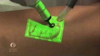 Augmented Reality VeinViewer technology on varicose veins treatment Novo Tratamento Varizes [upl. by Yuh495]