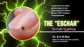 The quotESCHARquot Scrub Typhus  Dr B V N Rao MBBS MD MRCPUK and FRCP London [upl. by Sillert]