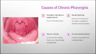 Pharyngitis by Dr Fatima Ammir [upl. by Vickey]