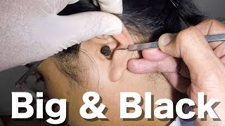 Big Black Earwax STUCK in Young Womans Ear Removed [upl. by Shari96]