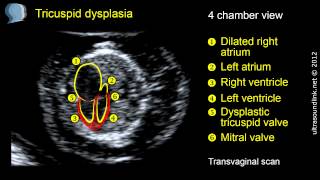 Tricuspid regurgitation TR in fetus tricuspid dysplasia at 12 week scan [upl. by Arihsat]