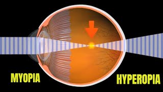 Myopia and Hyperopia [upl. by Eveleen]