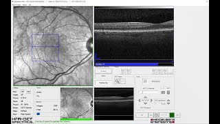 Recorded Webinar OCT LIVE Virtual Workshop  OCT Angiography Module [upl. by Lise]