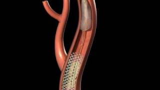 Protected Carotid Stenting [upl. by Isied]