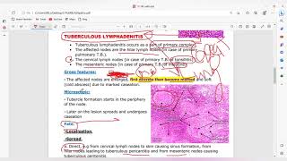 Non neoplastic lymhoma [upl. by Naujahs]