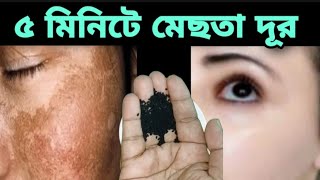 মাএ৫মিনিটে মেছতার দাগ থেকে চিরতরে মুক্তিঘরোয়া উপায়ে মেছতার দাগ দূরমেছতামেছতা হলে কি করবেন [upl. by Jules]