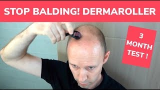 STOP BALDING  Dermaroller 3 Month Test and Tutorial [upl. by Andros288]