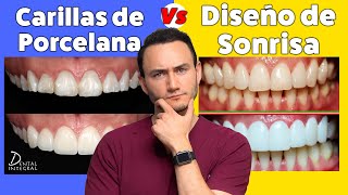 Carillas Dentales Vs Diseño de Sonrisa  Lo que tienes que saber antes de decidir [upl. by Noled540]