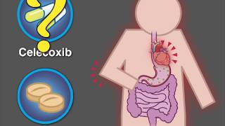 Cardiovascular Safety of Celecoxib  NEJM [upl. by Jarret]