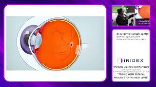 Subthreshold Laser in Chronic Central Serous Chorioretinopathy Ferdiriva Hamzah MD [upl. by Anaugal]