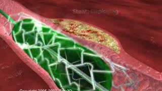 Medical Animation  Tres3d Stent Procedure how a stent is used 3d heart [upl. by Tonye]