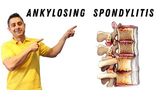 Ankylosing Spondylitis core exercises [upl. by Lilas]