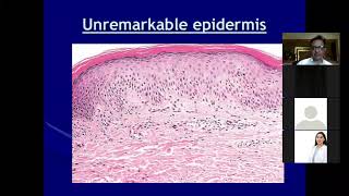 Lecture2 Dermatopathology Lichenoid and Interface Dermatitis [upl. by Cory667]