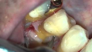 Surgical Resorption Repair [upl. by Suivatnom]