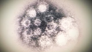 Mysterious Virus May Include Paralysis [upl. by Eirrol]