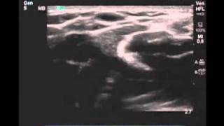 How To Peripheral Arm Veins for Vascular Access Scanning Technique Video [upl. by Viridissa]