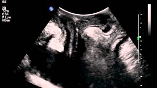 rectocele pelvic floor ultrasound [upl. by Anor]