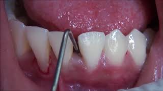 Sondeo periodontal [upl. by Attenod]