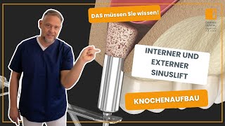 So funktioniert interner und externer Sinuslift Knochenaufbau für Zahnimplantate [upl. by Windsor]