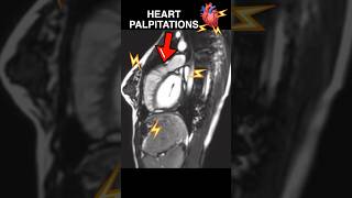 Heart PALPITATIONS under MRI🫀⚡️ anxiety cardiology [upl. by Leyes821]