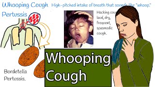 Whooping cough  Pertussis Hacking cough Symptoms and treatment [upl. by Cox]