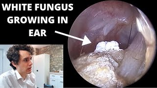 White Fur Growing in Ear Removed With Suction Otomycosis Fungal Infection [upl. by Stanleigh]