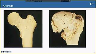 Vortrag „Hüftarthrose – Behandlung und ENDOprothetik“ – Dr Hans Mau Leitender Oberarzt [upl. by Etnaik]