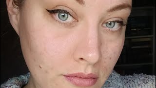 SKINCARE UPDATE acne blemish oilyskin skincare beauty [upl. by Aicekal789]