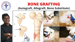 BONE GRAFTING  Lecture 05  Orthopedics [upl. by Treble]