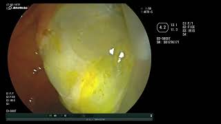 ruptured hydatid cyst in the common bile duct [upl. by Asila]