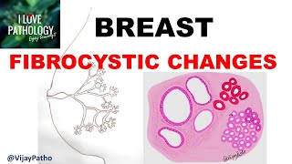 Diseases of Breast Part 1 Normal anatomy Classification amp FIBROCYSTIC CHANGES [upl. by Reni539]