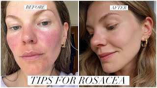 Rosacea 4 skincare products amp treatments that work [upl. by Naynek]